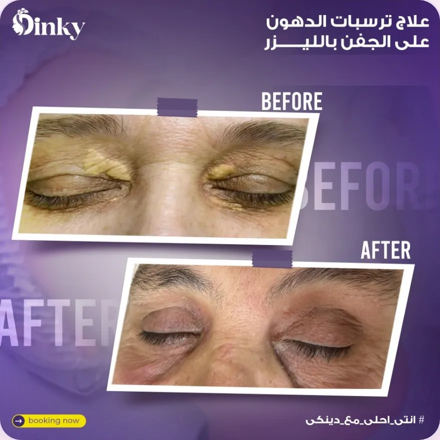قبل وبعد — علاج ترسبات الدهون على الجفن بالليزر