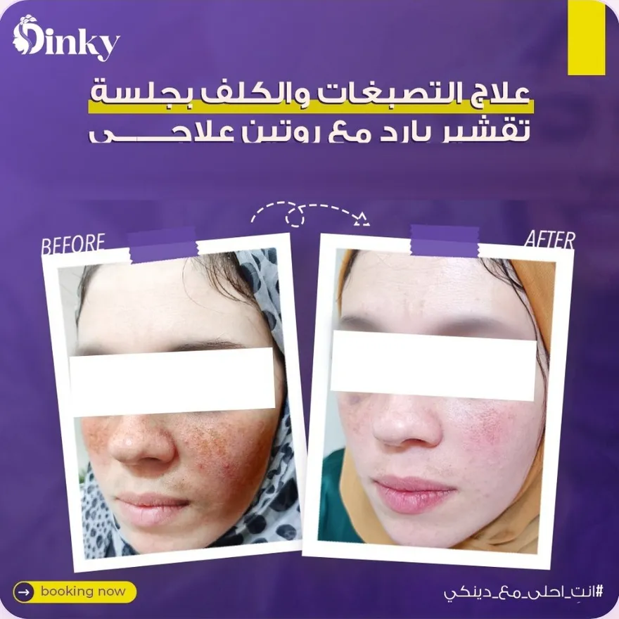 قبل وبعد — علاج التصبغات والكلف بجلسة تقشير بارد مع روتين علاجي