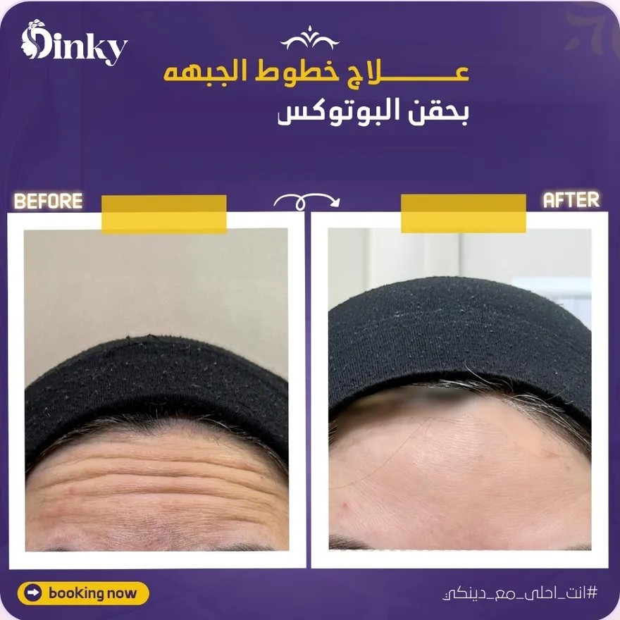 قبل وبعد — علاج خطوط الجبهة بحقن البوتوكس