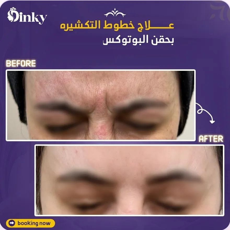 قبل وبعد — علاج خطوط التكشيرة بحقن البوتوكس