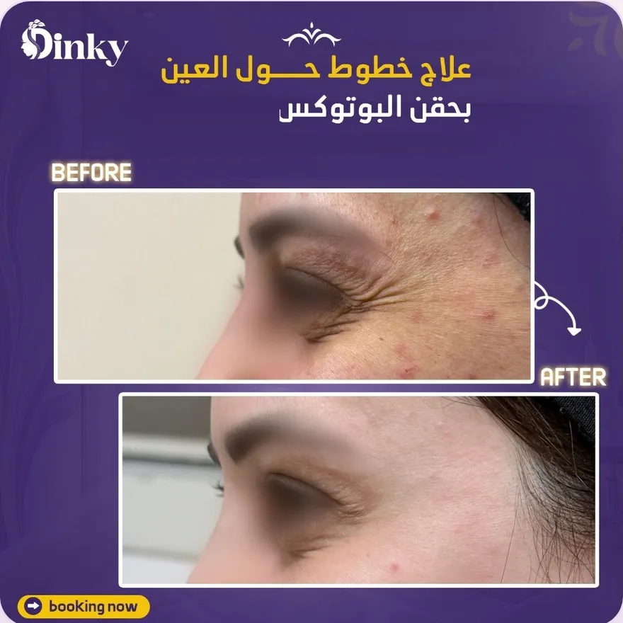 قبل وبعد — علاج خطوط حول العين بحقن البوتوكس