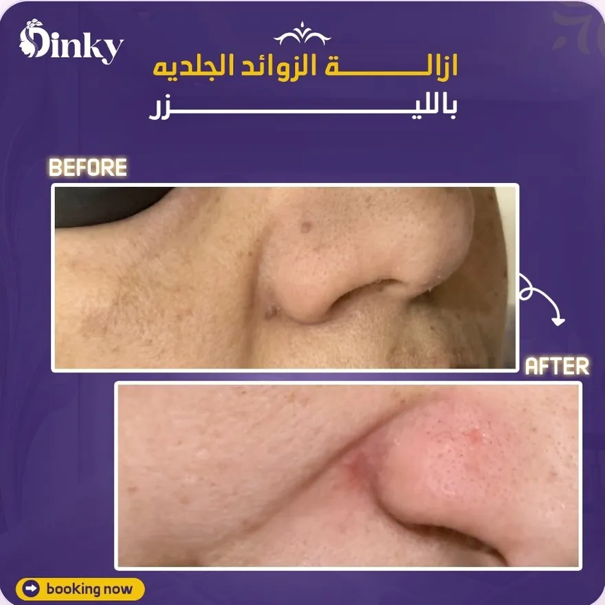 قبل وبعد — إزالة الزوائد الجلدية بالليزر