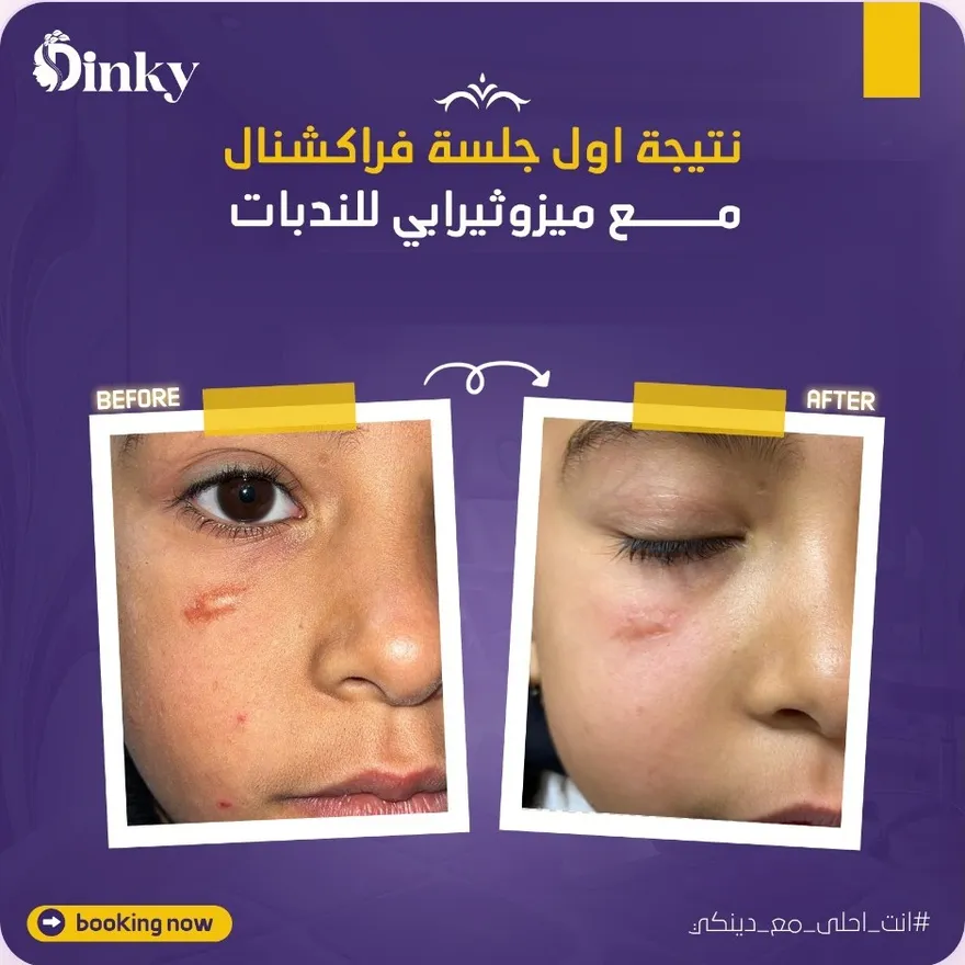 قبل وبعد — نتيجة أول جلسة فراكشنال مع ميزوثيرابي للندبات