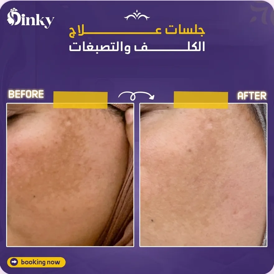 قبل وبعد — جلسات علاج الكلف والتصبغات