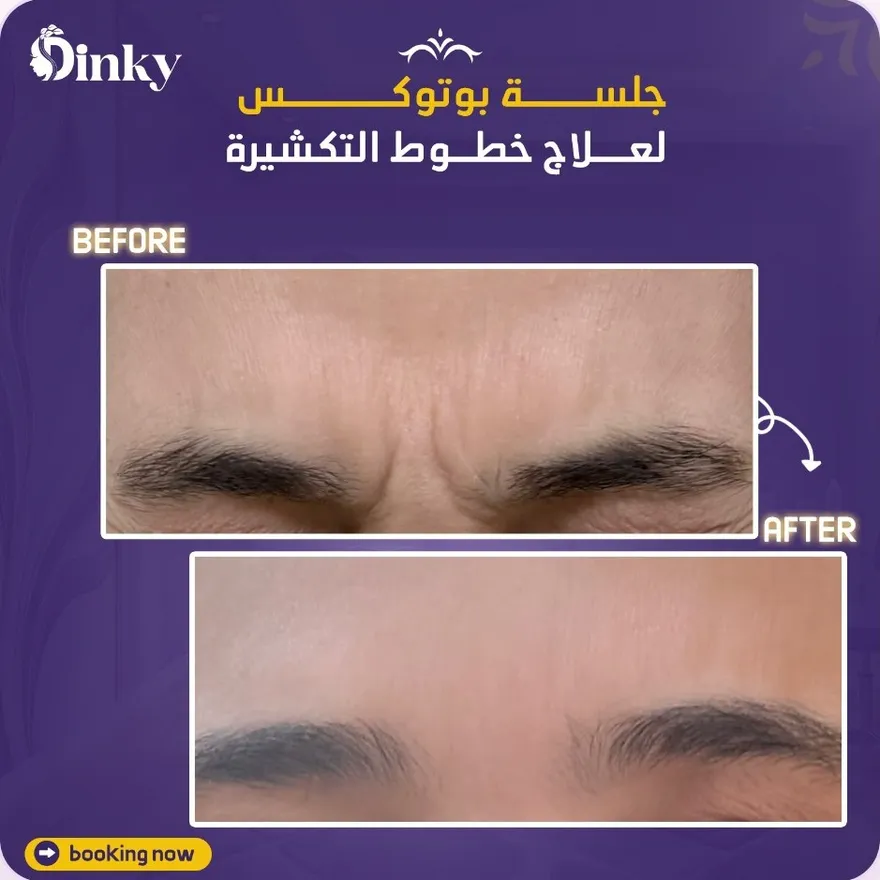 قبل وبعد — جلسة بوتوكس لعلاج خطوط التكشيرة