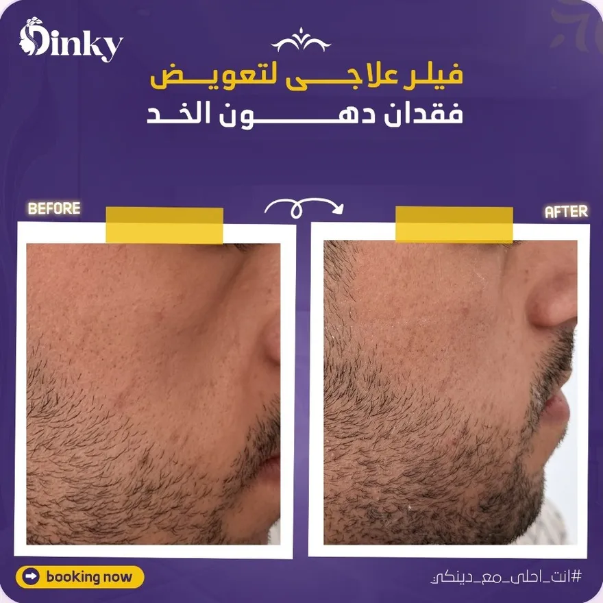 قبل وبعد — فيلر علاجي لتعويض فقدان دهون الخد