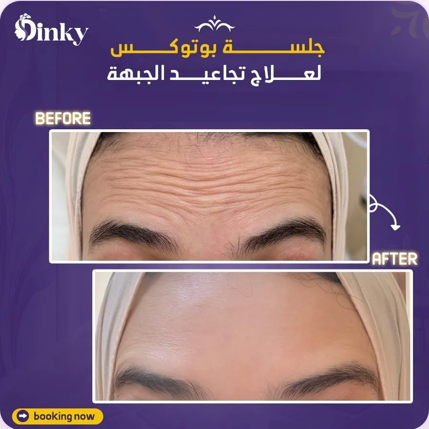 قبل وبعد — جلسة بوتوكس لعلاج تجاعيد الجبهة