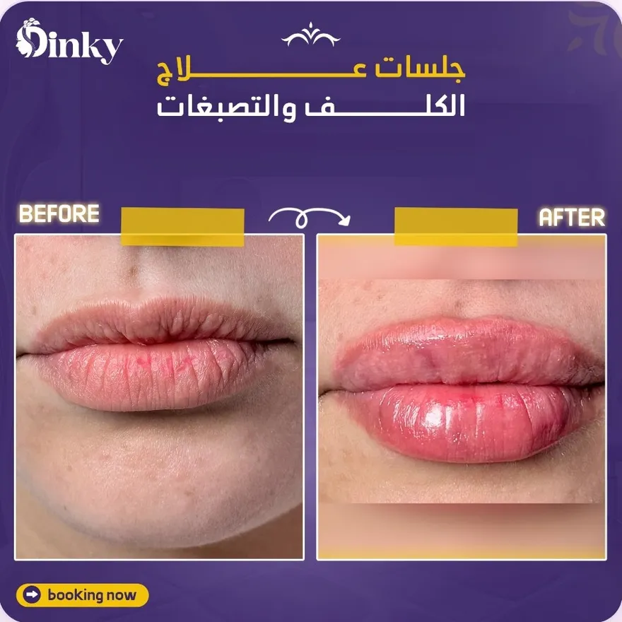 قبل وبعد — جلسات علاج تصبغات الشفايف