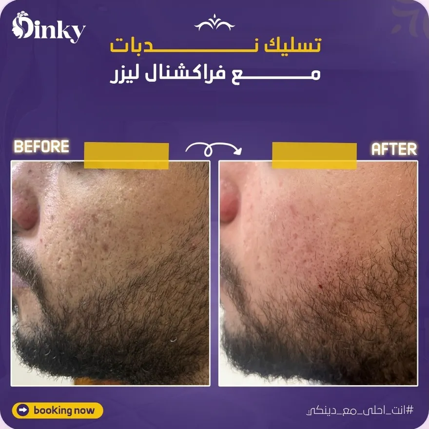 قبل وبعد — تسليك ندبات مع فراكشنال ليزر