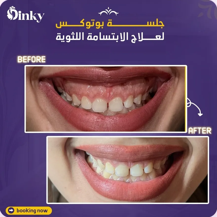 قبل وبعد — جلسة بوتوكس لعلاج الابتسامة اللثوية
